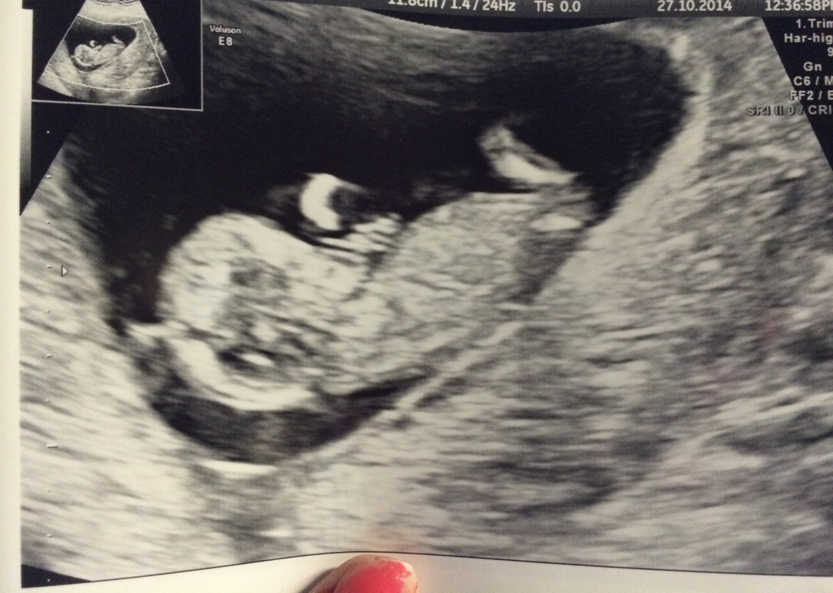 Klassisk ultralydsbillede af ufødt barn