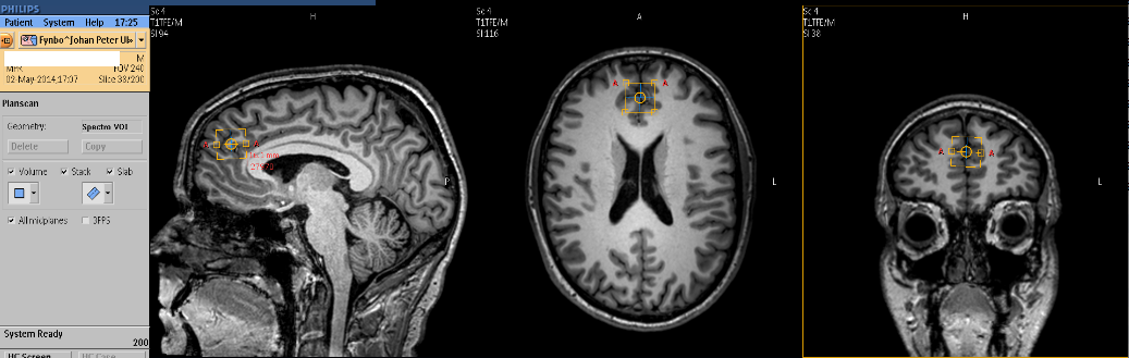 En MR scanning af min hjerne.